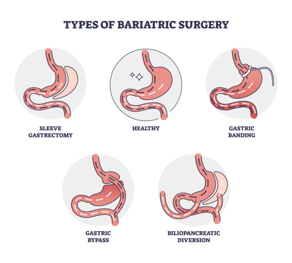 Types of bariatric surgery